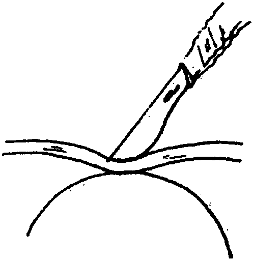 第六節(jié) 剖宮產(chǎn)術(shù)對(duì)胎兒可能造成的誤傷